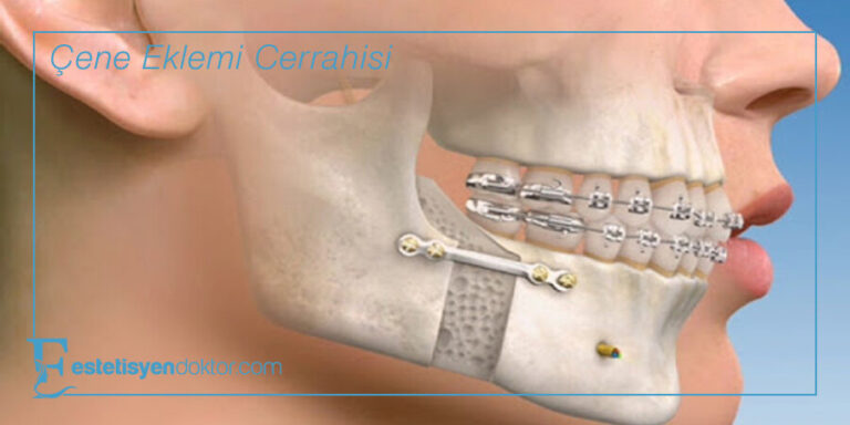 Çene Eklemi Cerrahisi Nedir? 2023