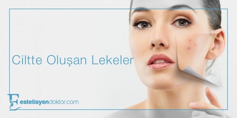 Cilt Lekeleri Neden Olur ve Nasıl Geçer?