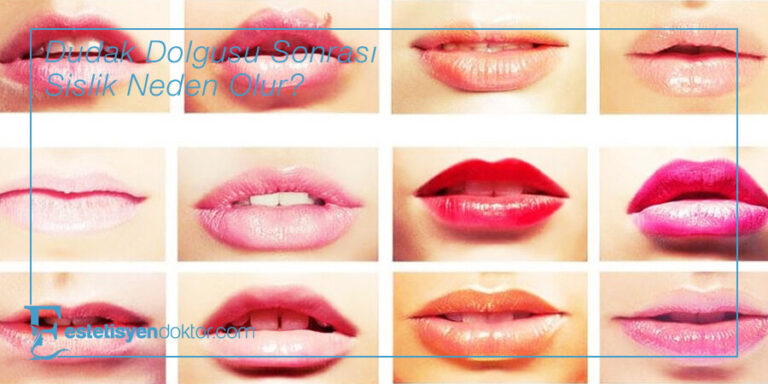 Dudak Dolgusu Sonrası Şişlik Neden Olur?