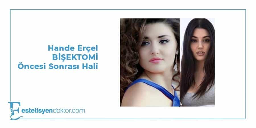 Hande Erçel BİŞEKTOMİ Öncesi Sonrası Hali