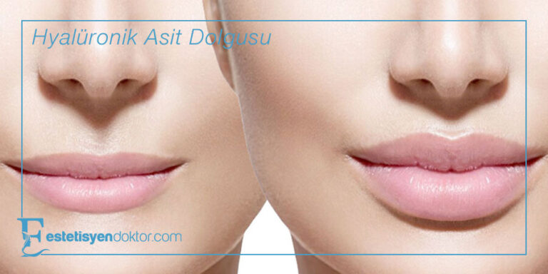 Hyalüronik Asit Dolgusu