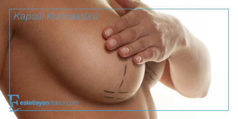 Kapsül Kontraktürü Nedir?