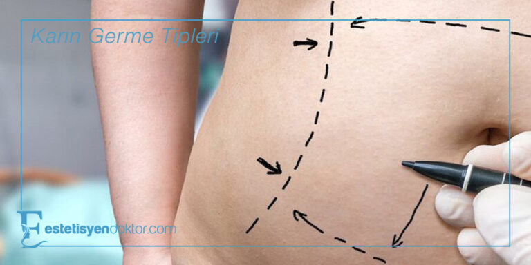 Karın Germe Tipleri