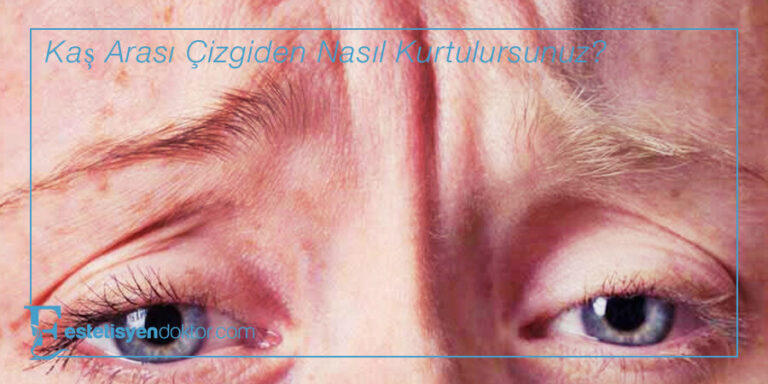 Kaş Arası Çizgiden Nasıl Kurtulursunuz?