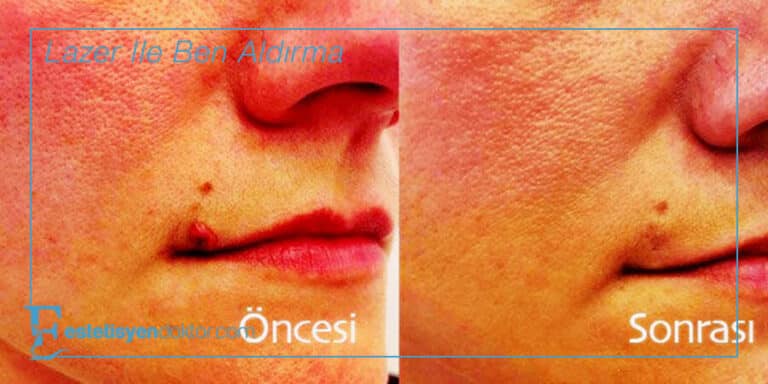 Lazer ile Ben Aldırma – 2023