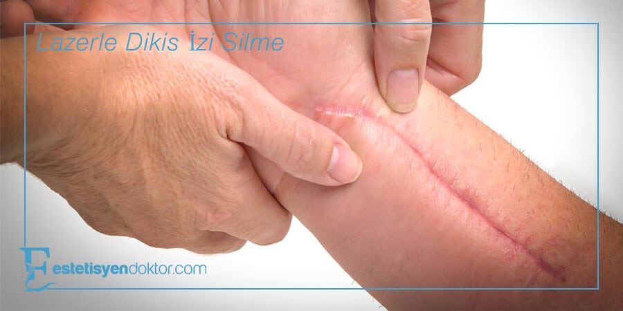 Lazerle Dikiş İzi Silme - Estetisyen Doktor