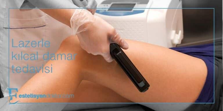 Lazerle Kılcal Damar Problemi Tedavisi Uygulamaları
