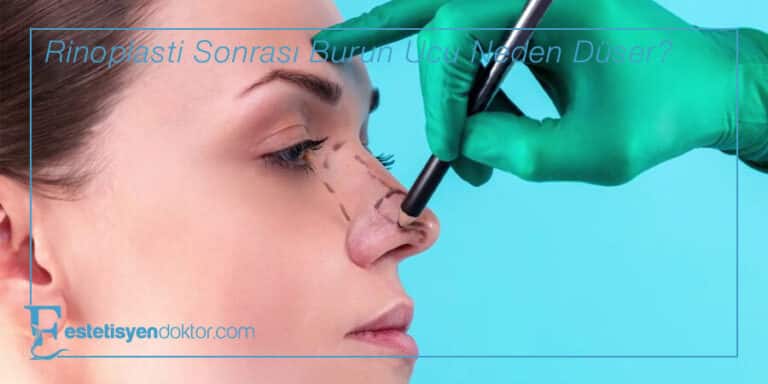 Rinoplasti Sonrası Burun Ucu Neden Düşer