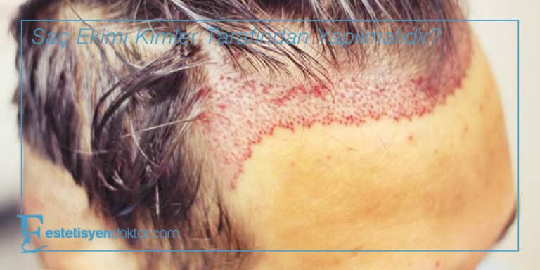 Saç Ekimi Kimler Tarafından Yapılmalıdır