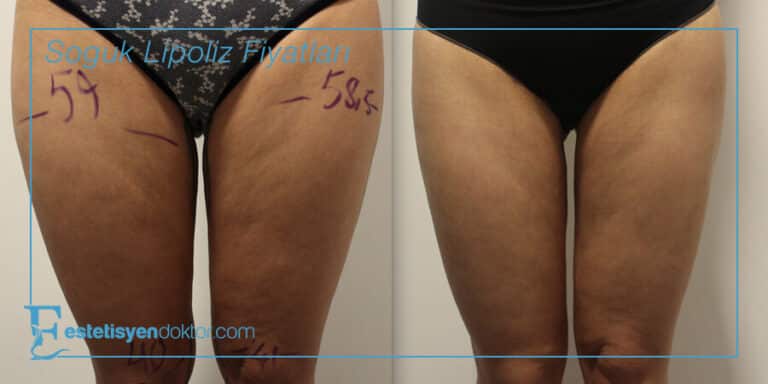 Soğuk Lipoliz Fiyatları
