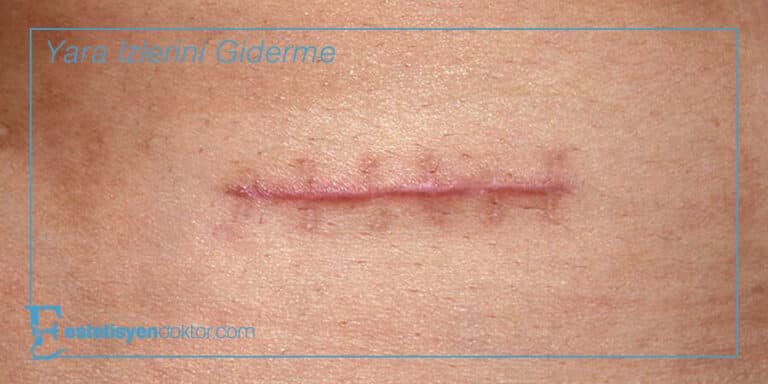Yara İzlerini Giderme En İyi 10 Çözüm
