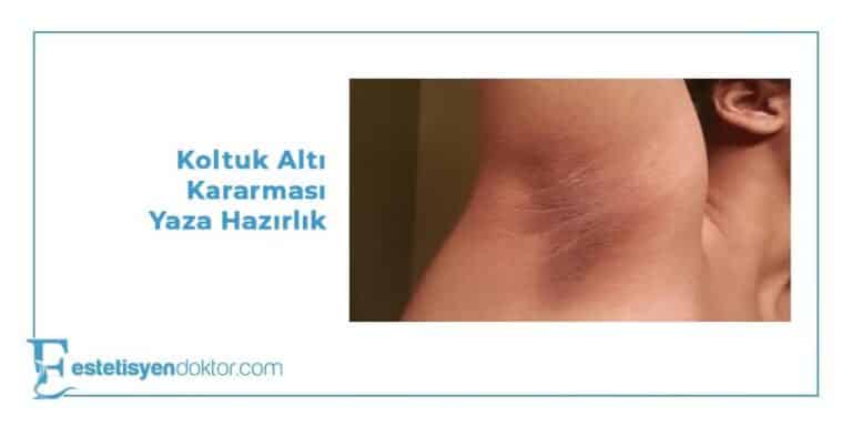 Koltuk Altı Kararması Nasıl Geçer?