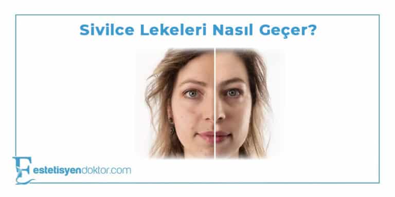Sivilce Lekeleri Nasıl Geçer?