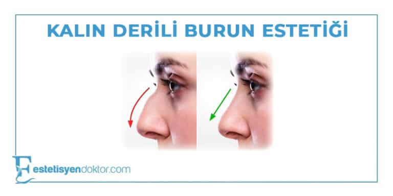 Kalın Derili Burun Estetiği