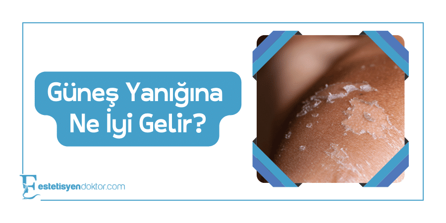 Güneş Yanığına Ne İyi Gelir? - Estetisyen Doktor